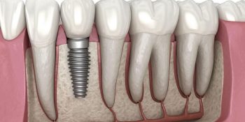 Implanturile dentare: tot ce trebuie să știm despre implanturi și procedura de inserare implant